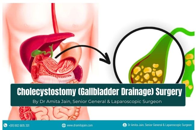Cholecystostomy Gallbladder Drainage Surgeon - Dr Amita Jain